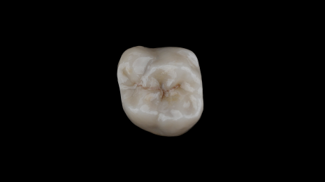 Nano-ceramic blocks milled for Lava Ultimate restorations