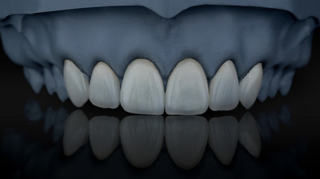 Lithium disilicate crowns with incisal translucency