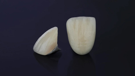 Indirect light-cured composite inlays on model